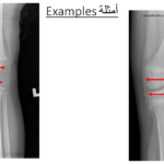 Normal alignment (16)