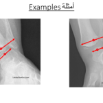 Normal alignment (18)