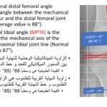 Normal alignment (25)